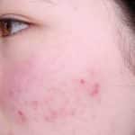 The Best Way to Get Rid Of Stubborn Acne Scars Utterly