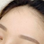 Effective ways to deal with hairline acne