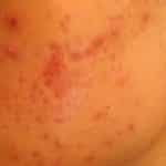 Excellent Powerful Natural Remedies For Curing Acne